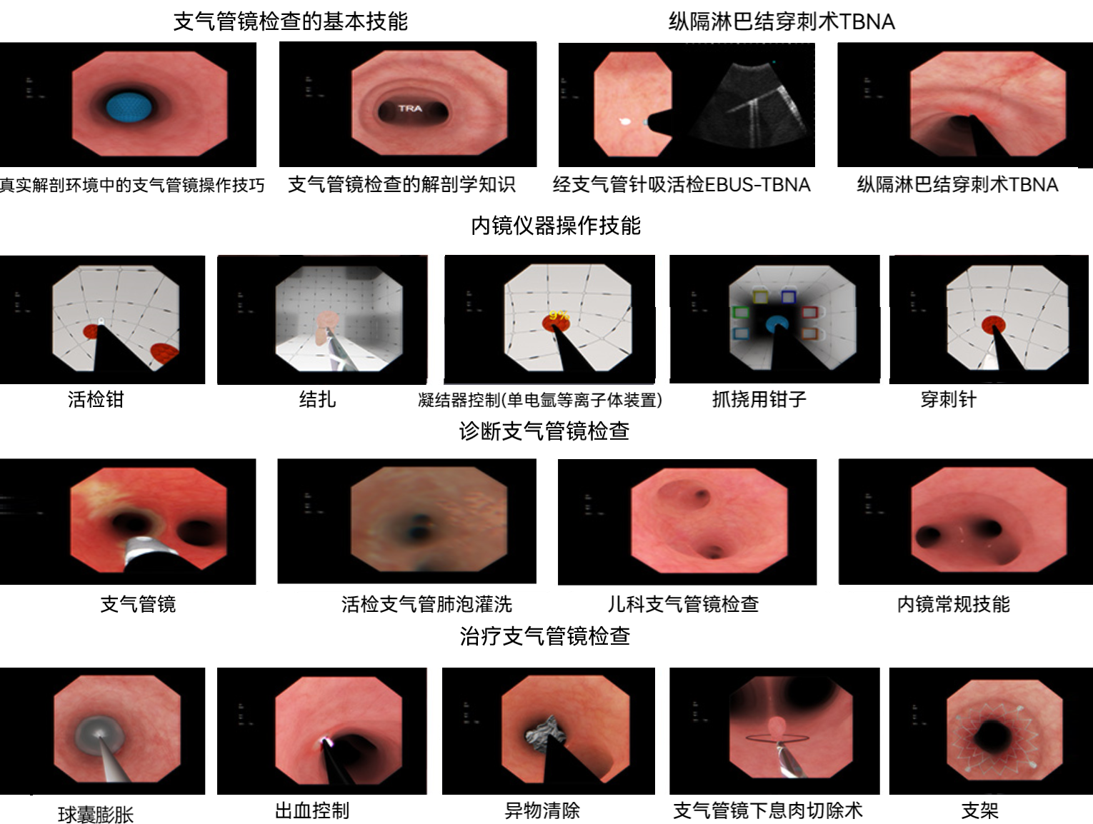   支气管镜检查