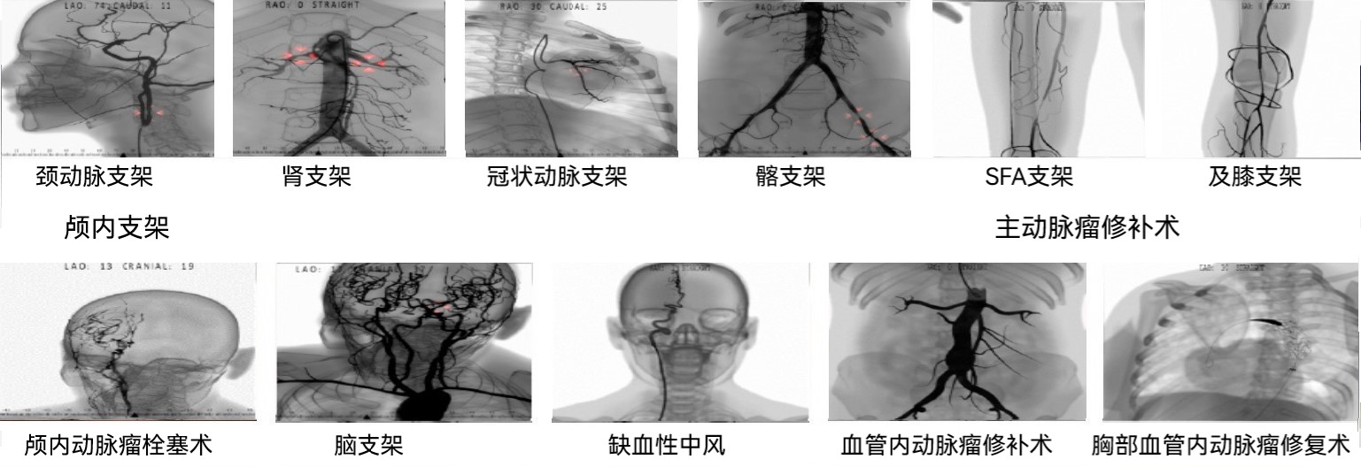 球囊血管成形术和支架置入